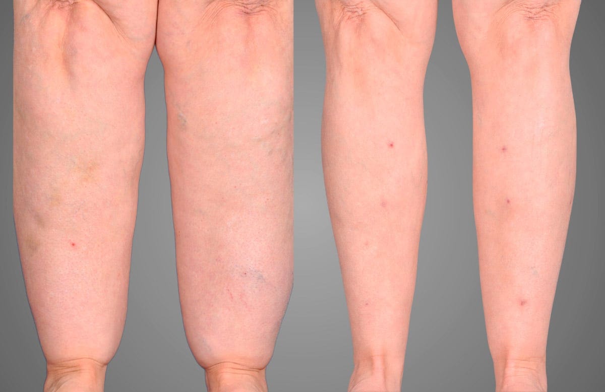 Documented patient case: lower legs before (left) and after (right) GentleSculpt lipedema treatment by Dr. Hall