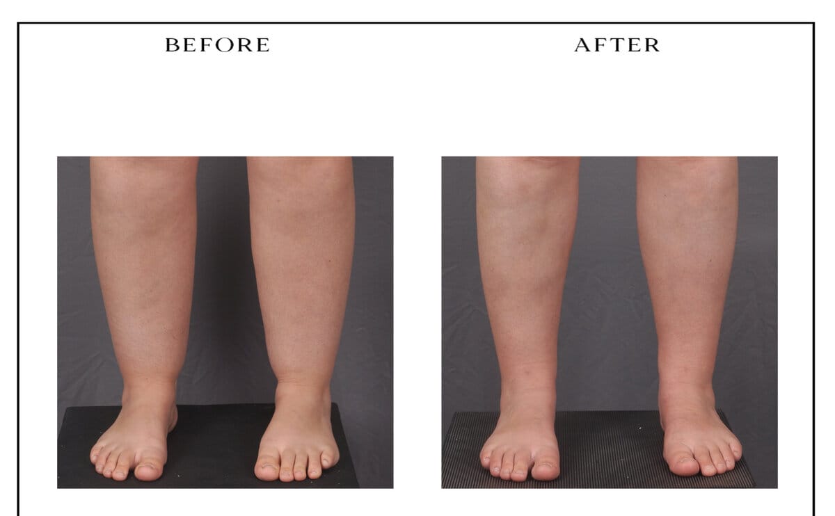 Lipedema treatment — anterior calves and ankles, before and after (same patient as posterior view above).