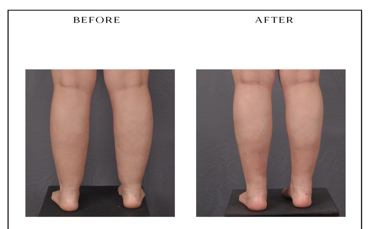 Lipedema treatment — posterior calves, before and after.