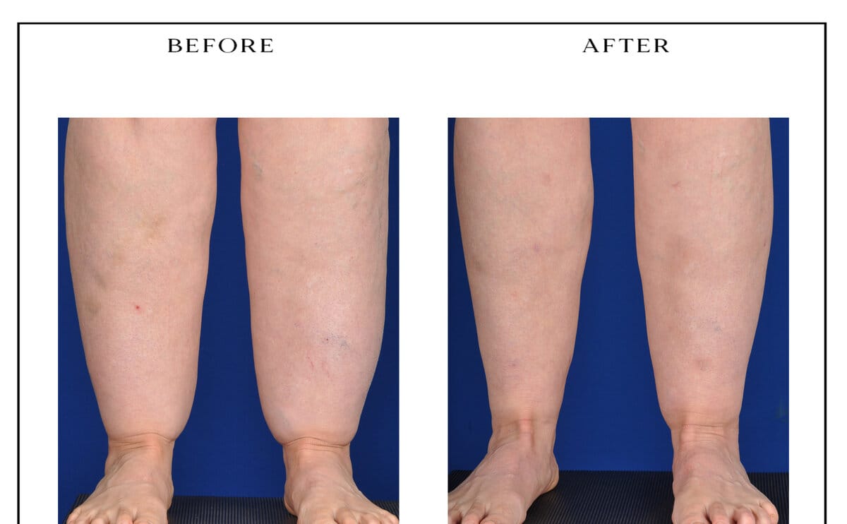 Lipedema treatment — anterior calves and ankles, before and after.