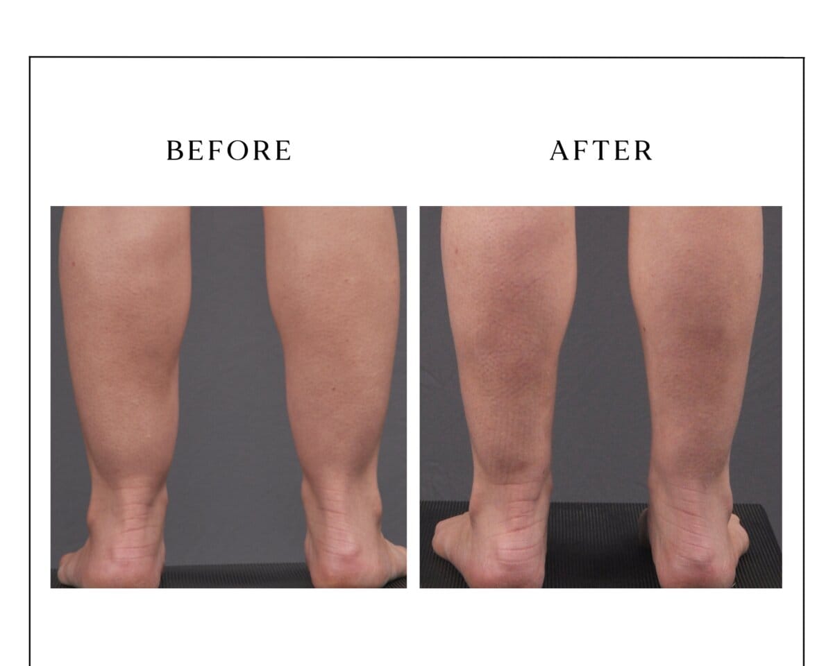 Lipedema treatment — posterior calves, before and after.