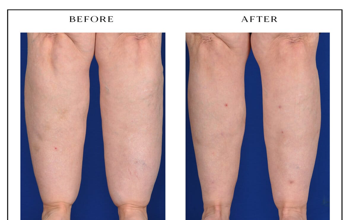 Lipedema treatment — anterior calves, before and after.