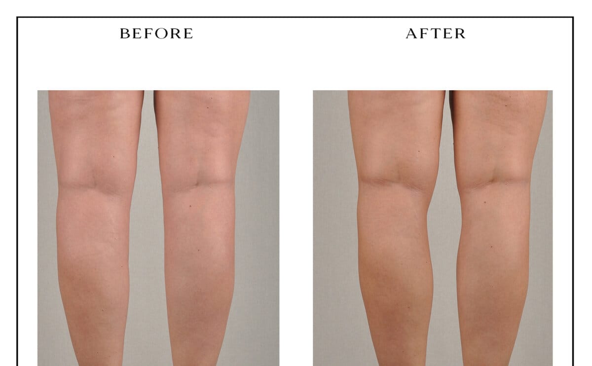 Lipedema treatment — knees and upper calves, before and after.