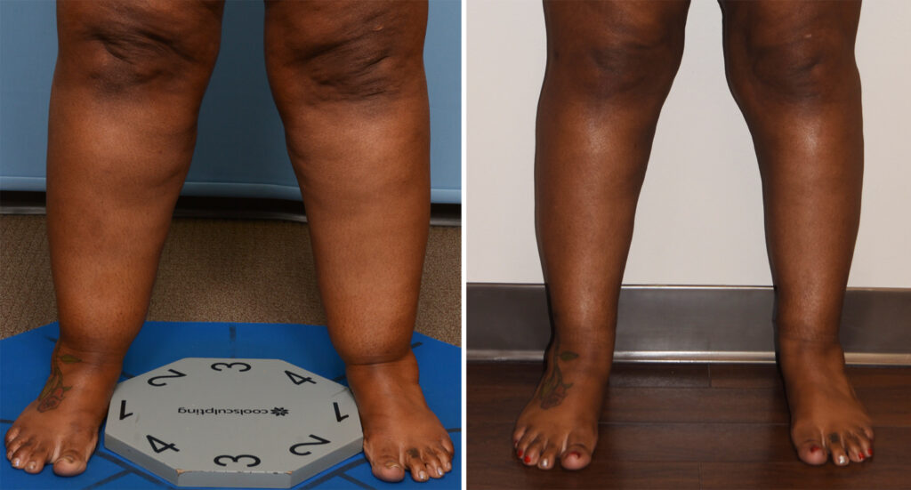 Lipedema and Hormone Replacement Therapy: Estrogen, Risks, and Management