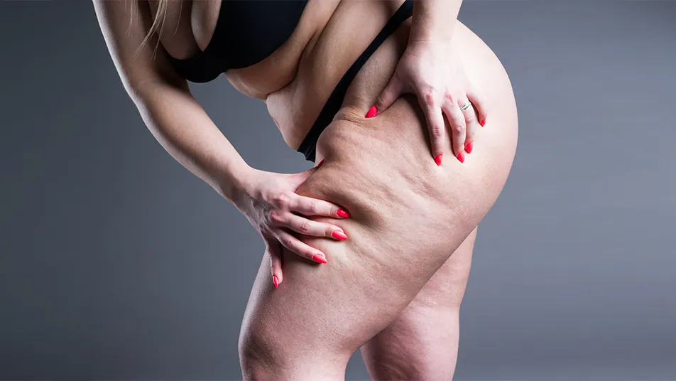 Lipedema Surgery While Breastfeeding: What to Know