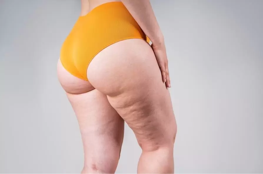 Is Lipedema Considered a Disability?