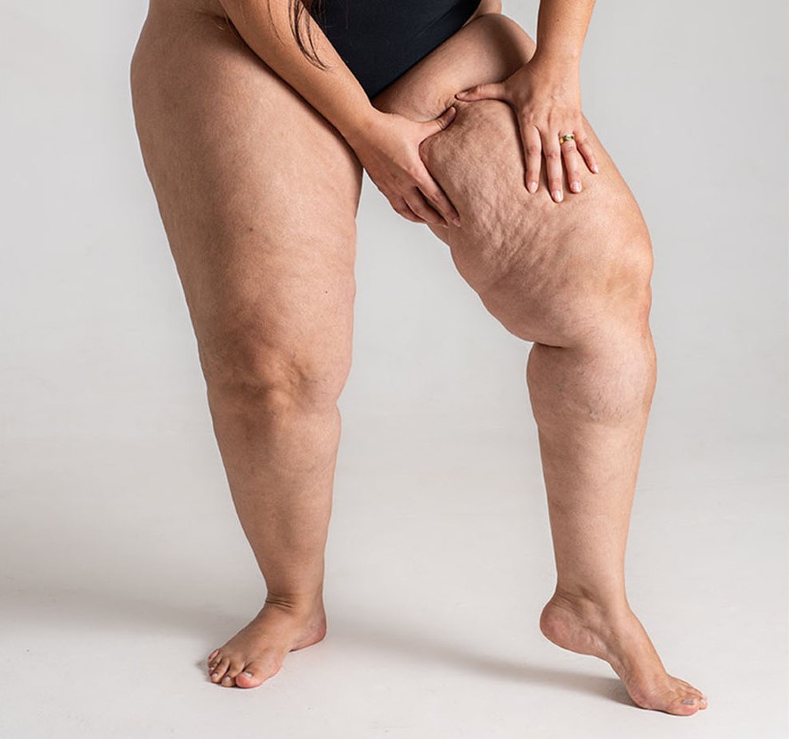 Best Shoes for Swollen Lipedema Legs