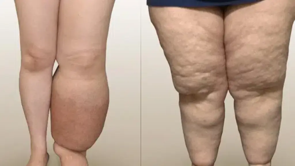 Blood Clots After Lipedema Surgery: DVT Risks, Symptoms, Diagnosis, and Prevention